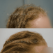 Natural Hair Loss Treatment in Canberra