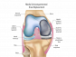Ease Your Knee Pain with Partial Knee Replacement Surgery 