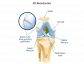 Restore Knee Strength with Precise ACL Ligament Reconstruction 