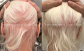 Natural Support for Alopecia Areata Recovery