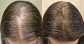 Natural Hair Regrowth Methods to Regrow Hair Naturally