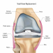 Knee Replacement Surgery for Pain Relief & Restoring Mobility