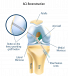 Restore Stability with torn ACL (Anterior Cruciate Ligament) surgery