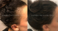 Female Hair Loss Solutions and Professional Guidance  