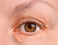 Support Clearer Eyelid Skin with Xanthelasma Removal Treatment