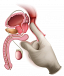 Vasectomy Services in Melbourne with Personalised Surgical Care