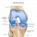 Torn ACL Surgery Begins with the Right Diagnosis